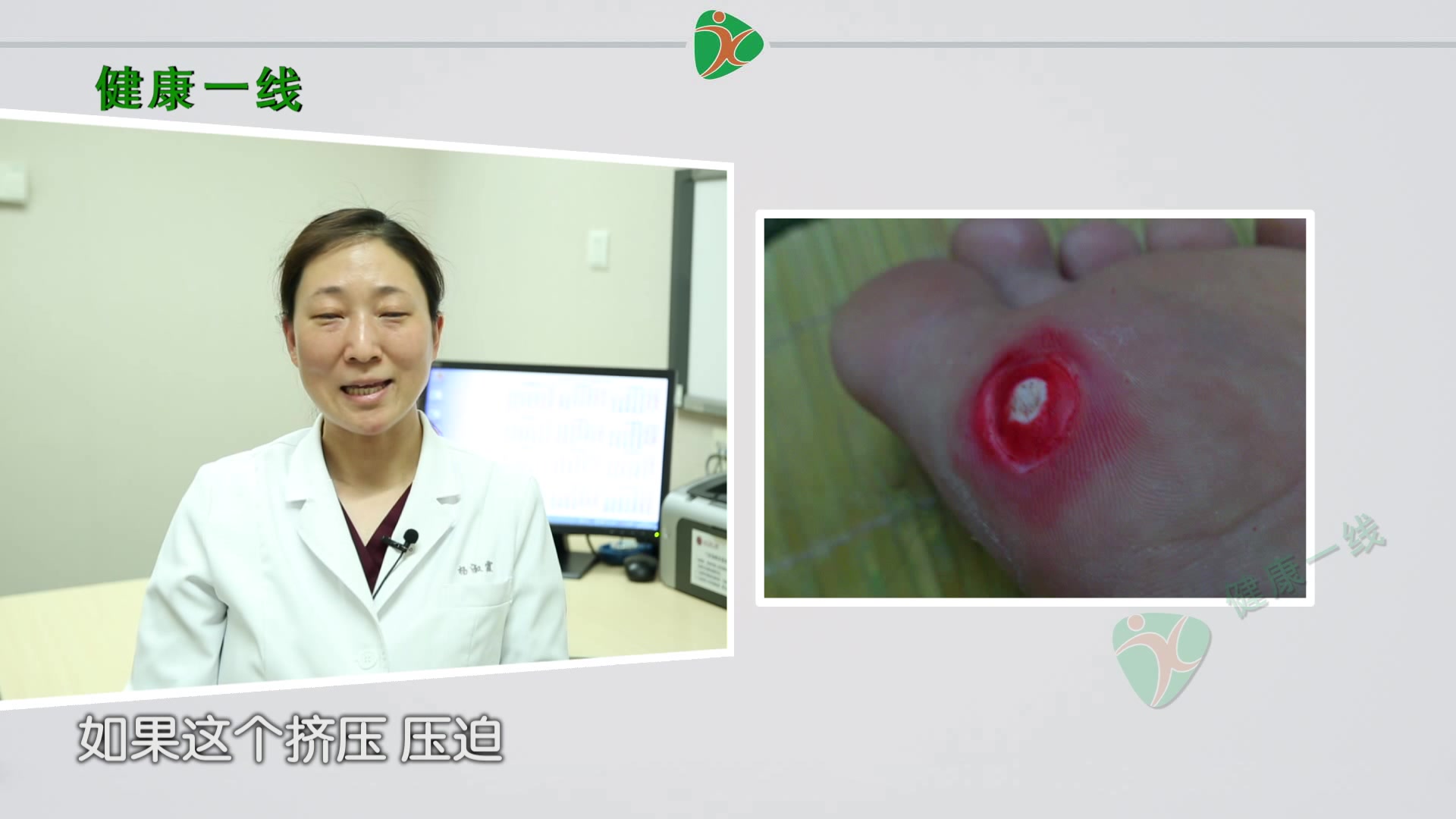 鸡眼传染吗?预防复发很重要