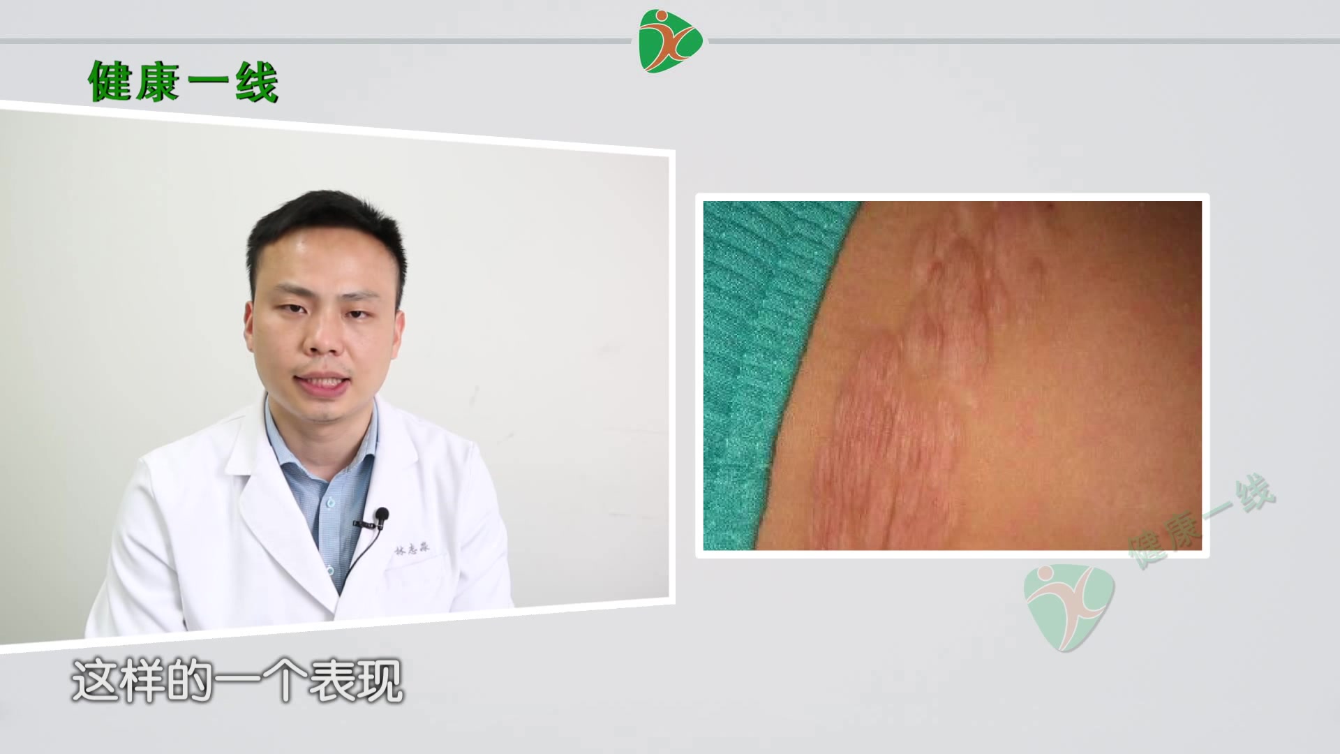 结节性硬化症是什么?常见的症状主要有癫痫或者智力发育迟缓