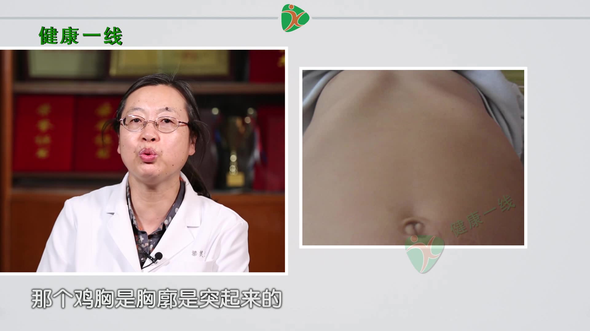 胸前凸出一块就是鸡胸吗？鸡胸的正确定义是什么？