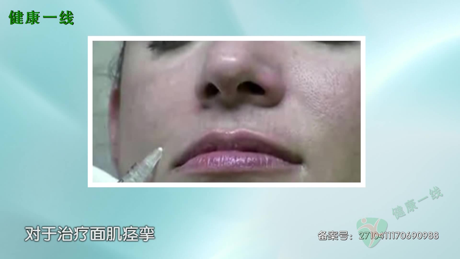 面肌痉挛可以用肉毒素治疗吗?只能短暂见效,不能根治